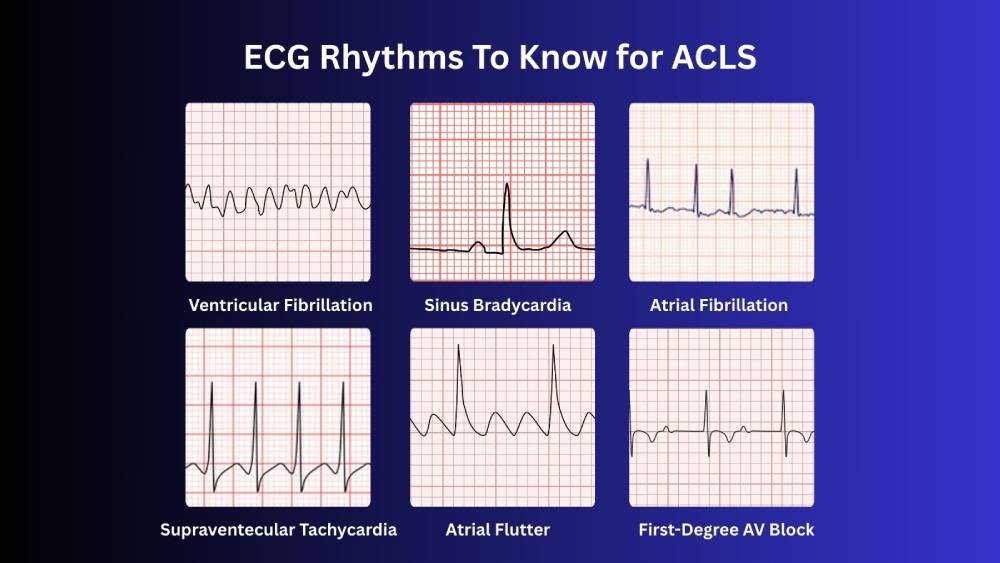 ECG Rhythms to Know for ACLS Certification