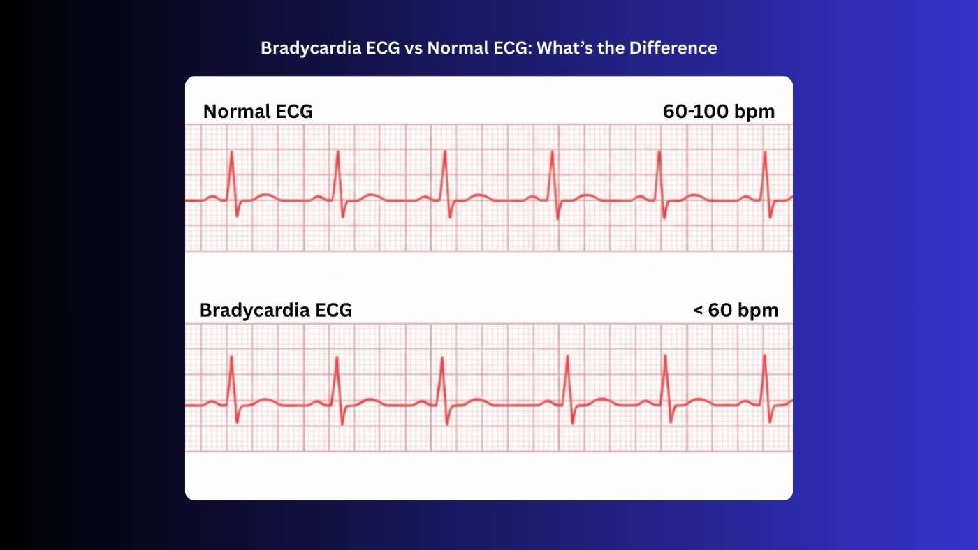 bradycardia ecg vs normal ecg